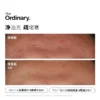 The Ordinary10%烟酰胺+1%锌提亮控油收毛孔淡化痘印胺锌三控精华