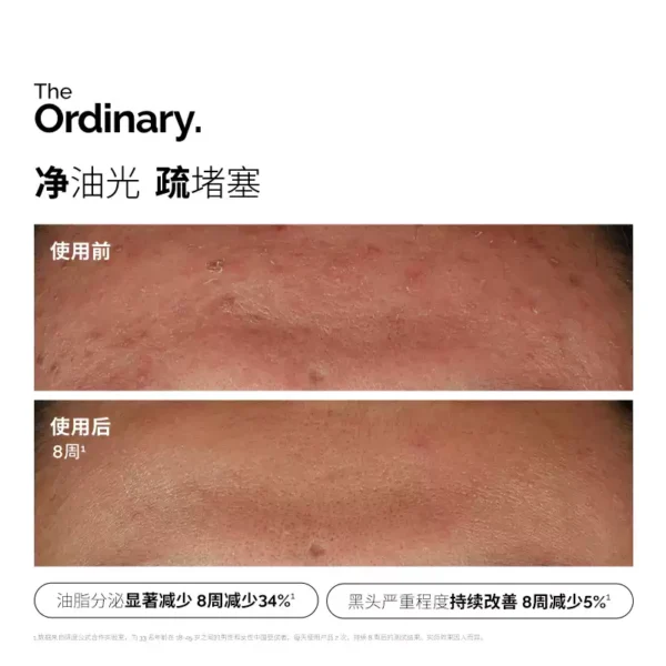 The Ordinary10%烟酰胺+1%锌提亮控油收毛孔淡化痘印胺锌三控精华